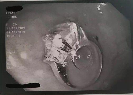 Una mujer soño tragarse anillo de compromiso y al despertar todo era cierto