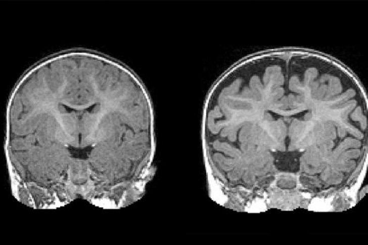 Un biomarcador predice si un bebé de seis meses desarrollará autismo