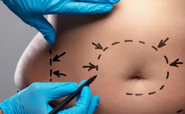 La delatan: Se hace una liposucción con el dinero que recolecto para su supuesto cáncer