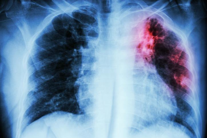 IMSS Tlaxcala advierte que detectar a tiempo la tuberculosis disminuye riesgo de muerte