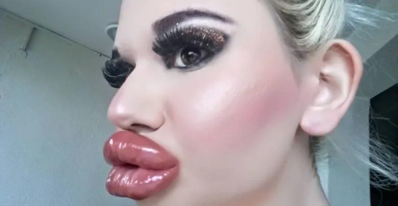 Mujer se inyecta ácido hialurónico 30 veces en los labios para ser toda una Barbie